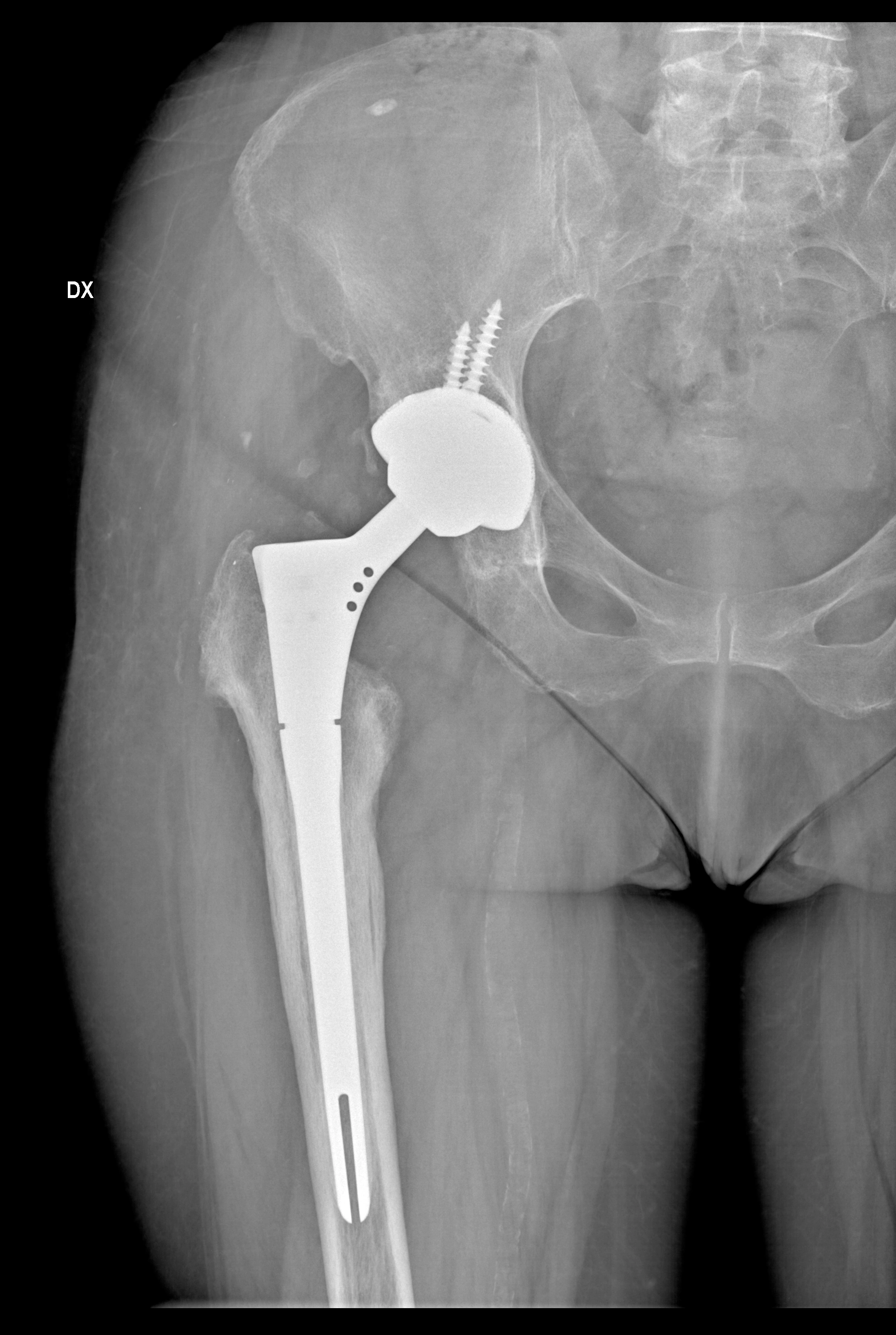 Radiografia anteroposteriore di revisione di protesi totale dell’anca destra
